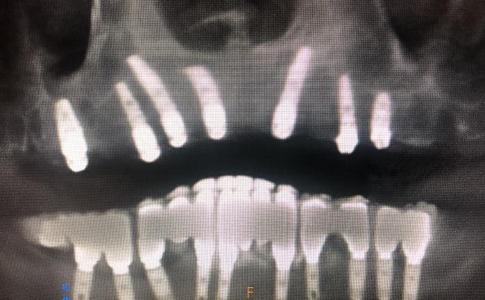 X-Ray After Extraction Of Upper Teeth And Placement Of Dental Implants