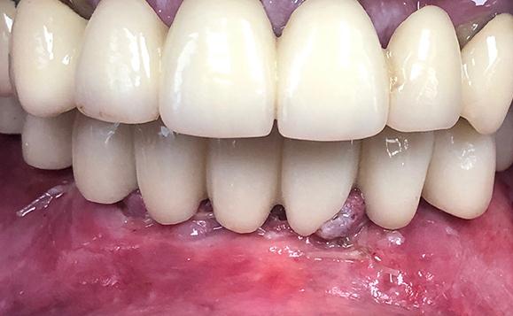 Patient Left With New Lower Implants And Temporary Teeth Same Day As Surgery