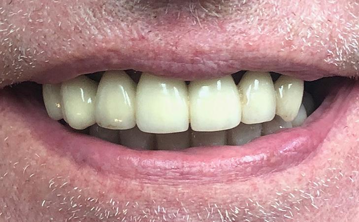 Patient Smiling After Extraction Of Upper Teeth And Placement Of Dental Implants And Temporary Teeth