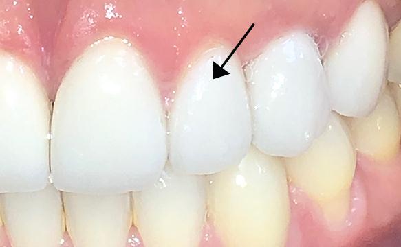 Closeup Of Final Crown And Implant #10