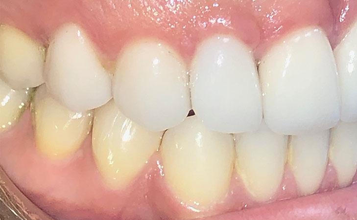 Final Restoration Of Right Lateral Implant