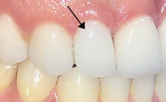 Closeup Of Final Tooth And Implant Crown #7