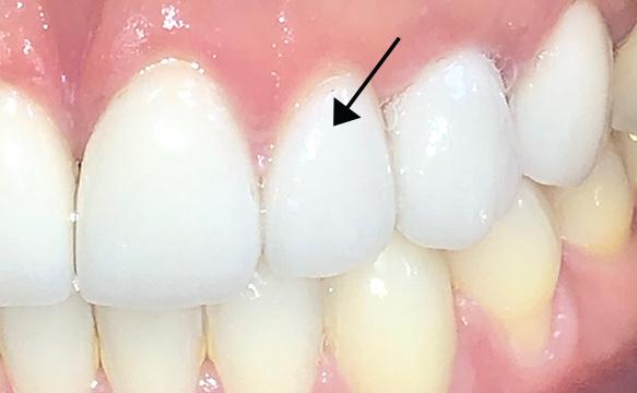 Closeup Of Final Crown And Implant #10