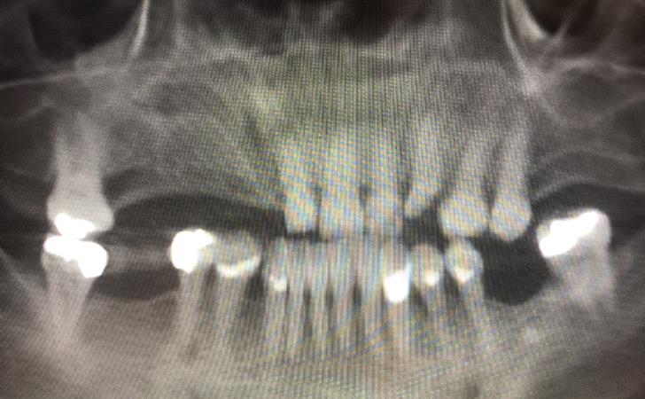 Patient X-Ray