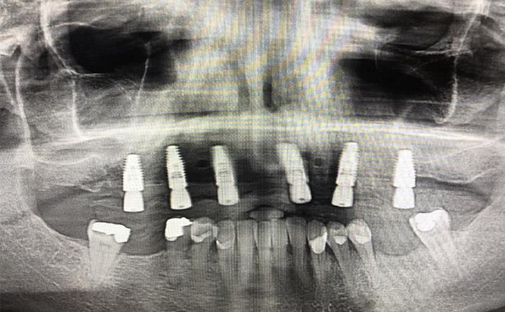 After Guided Implant Surgery