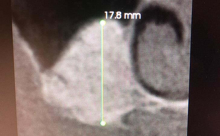 Sinus Lift Measuring 17.8mm