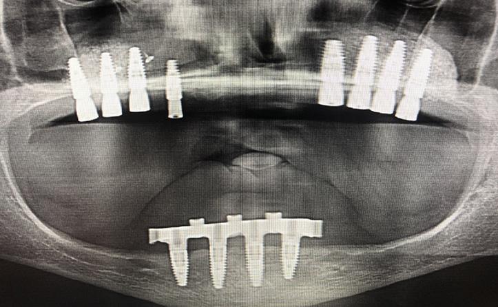 Bilateral Sinus Lifts