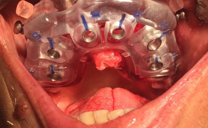 All-on-6 Implant Placement