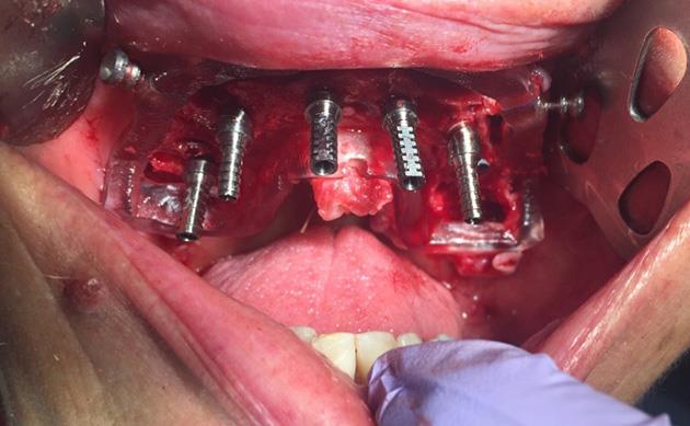 Placing All-on-6 Dental Implants