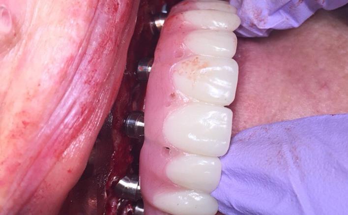 All-on-6 Dental Implants Temporary Bridge