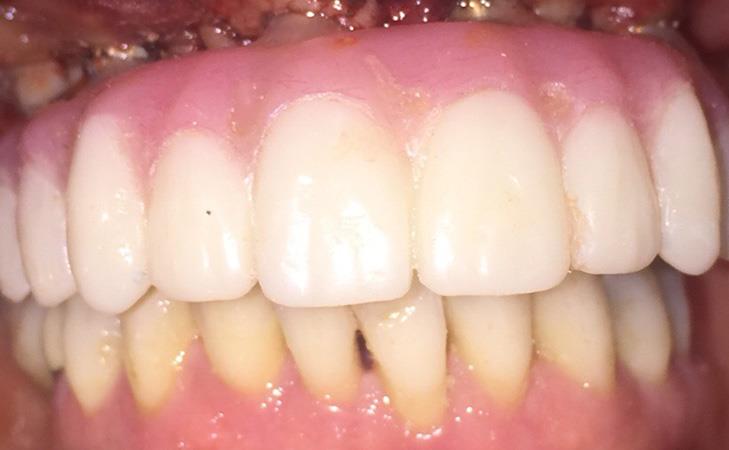 After All-on-6 Dental Implants