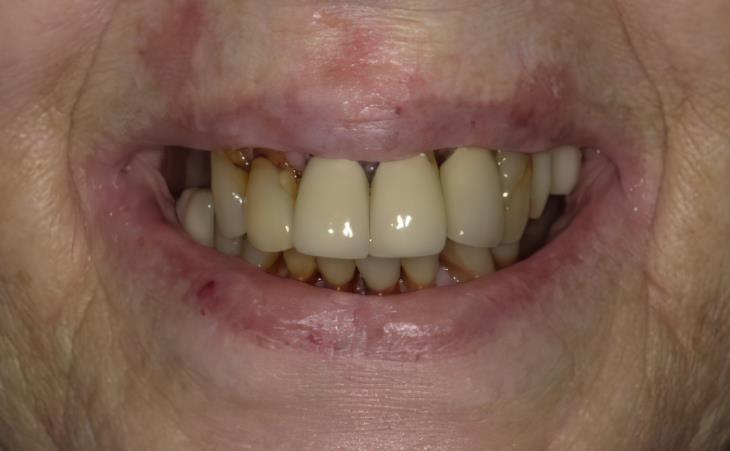 Before All-on-6 Dental Implants 