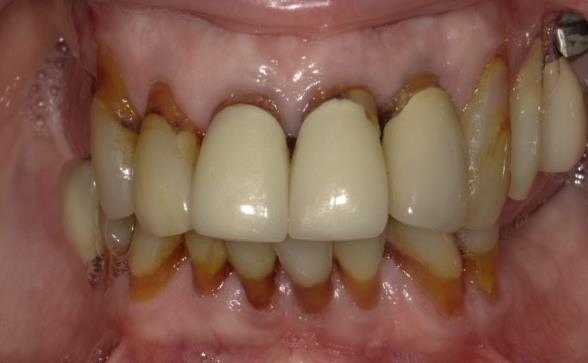 Patient Smile Before All-on-6 Dental Implants