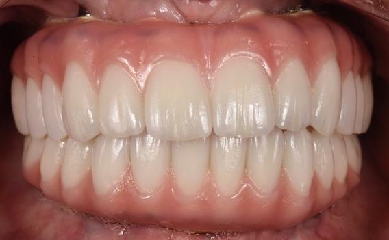 Results Of All-on-6 Dental Implants