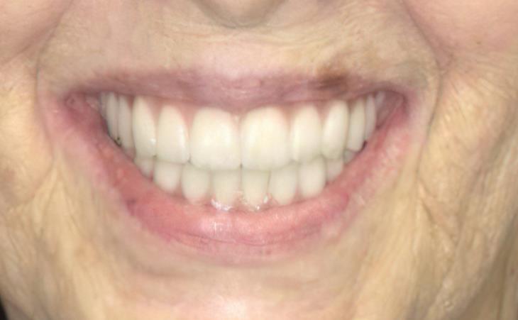 After All-on-6 Dental Implants 