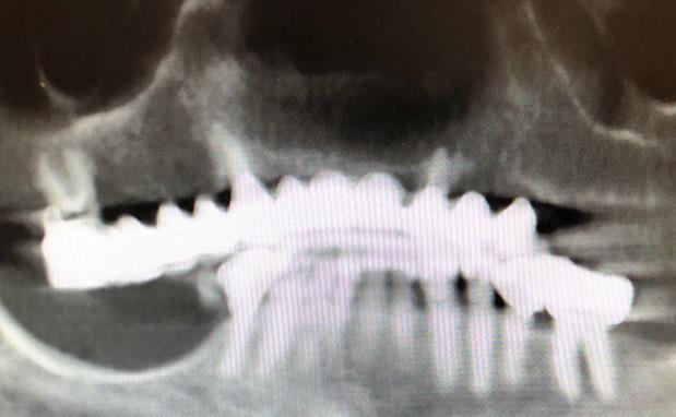 All-on-X Dental Implants X-Ray