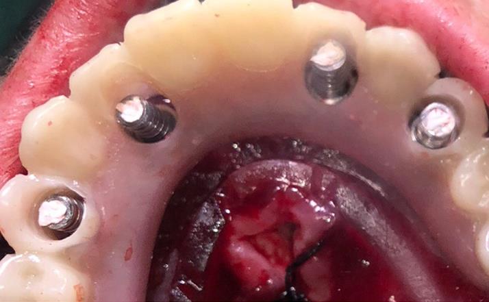 All-on-X Dental Implants Lower Jaw