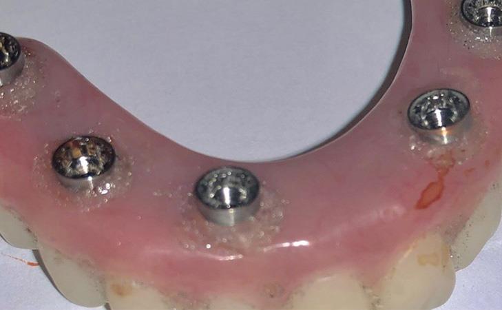 All-on-X Dental Implants Upper Teeth