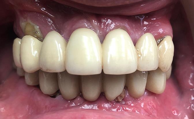 All-on-X Placement of Temporary Teeth