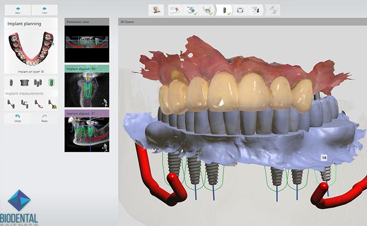 All-on-X Implant Planning