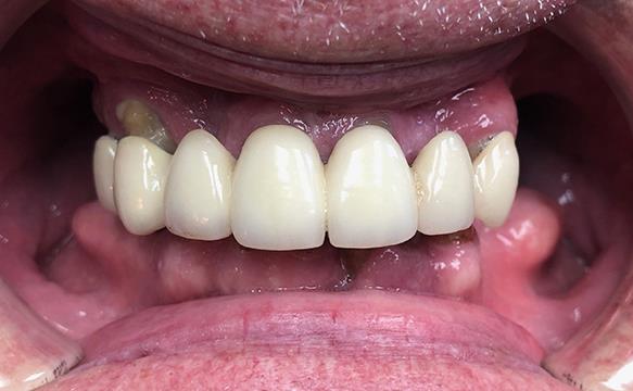 Before All-on-X Dental Implants Upper Jaw
