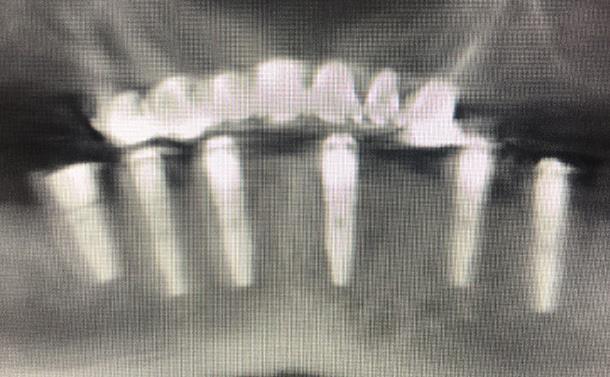 All-on-X Dental Implants Imaging