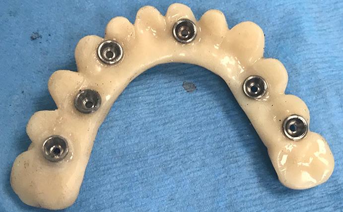 Full Arch All-on-X Implants