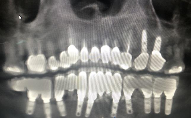 Upper & Lower All-on-X Implant X-Ray