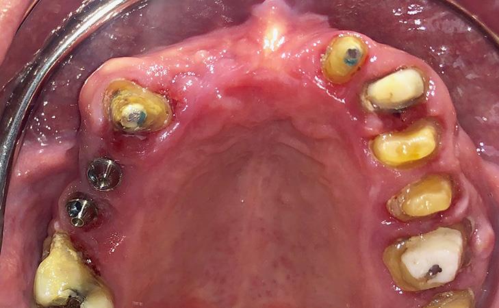 Upper Arch All-on-X Implants