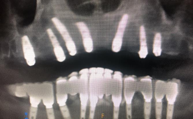During Upper Arch All-on-X Implants Procedure