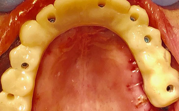 Upper Arch All-on-X Implant Procedure