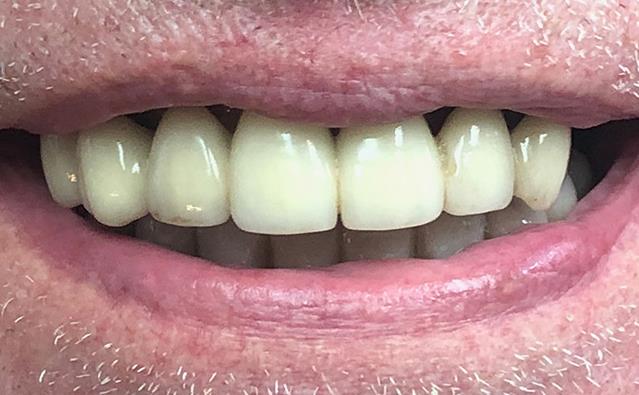 After All-on-X Dental Implants