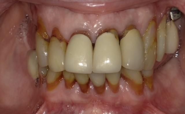 Replacing Upper and Lower Teeth