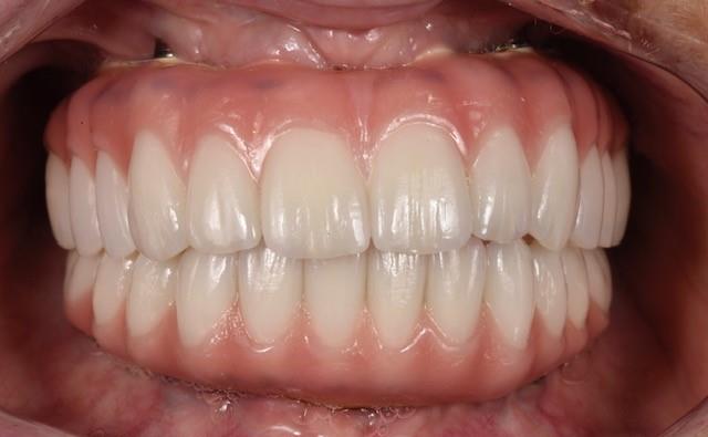 After Immediate Dental Implants