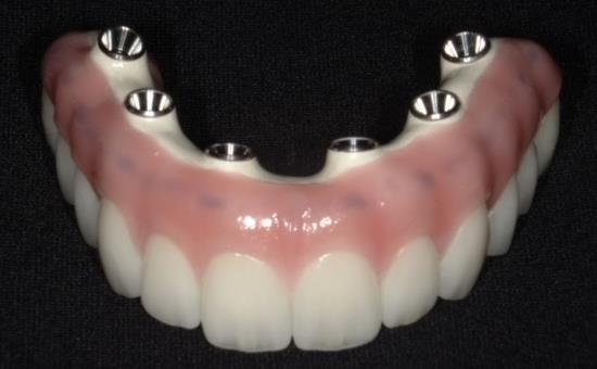 Top Set of Completed Dental Implants