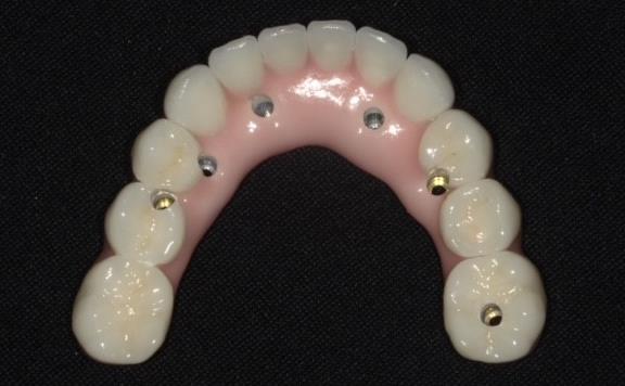 Bottom Set of Completed Dental Implants
