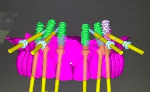 Guided Computer Planning for Immediate Implants