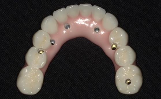 Completed Dental Implants – Bottom Set