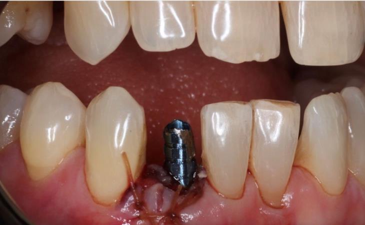 Titanium Screw Implant Post