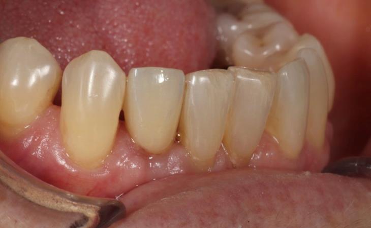 Repaired Tooth After Dental Implant