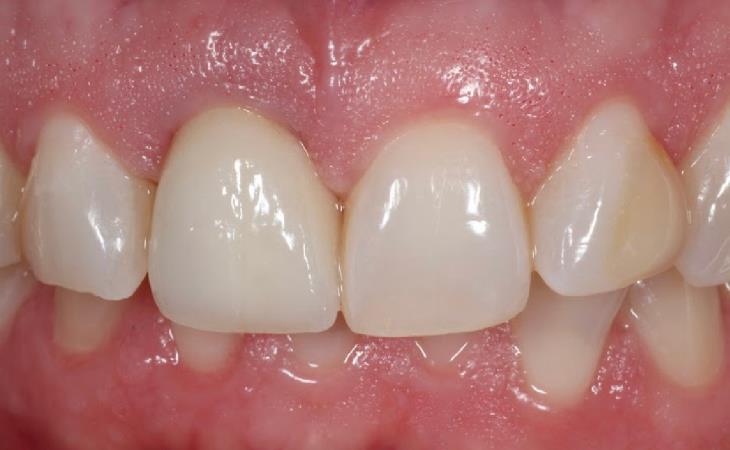 Front Tooth with Implant After