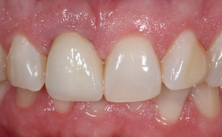 After - Front Tooth with Implant
