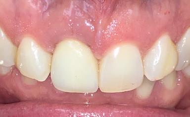 After Dental Implant to Replace Broken Tooth
