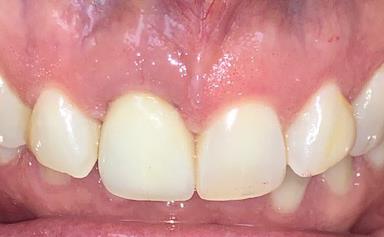Results of Broken Tooth Replacement using Dental Implant