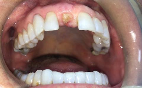 Site of Broken Tooth After Extraction