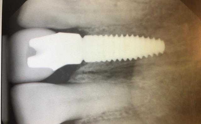 X-ray of Dental Implant for Broken Tooth Replacement