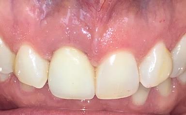 Results of Broken Tooth Replacement using Dental Implant
