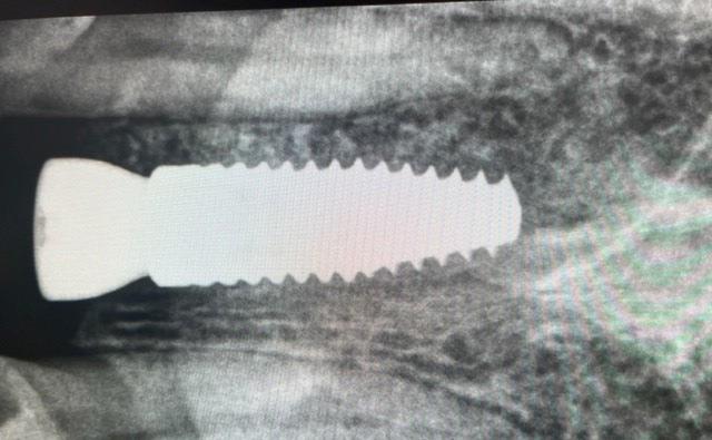 X-ray of Front Tooth Implant Screw