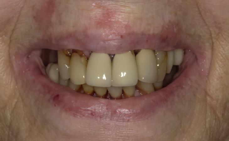 Before Immediate Dental Implants