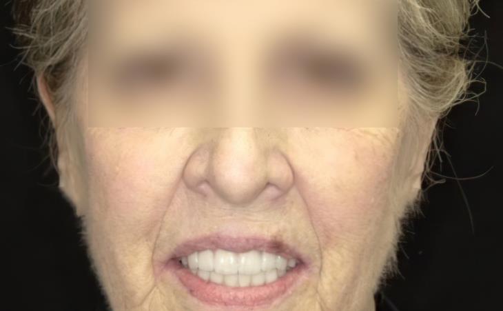 After Immediate Dental Implants – Front View